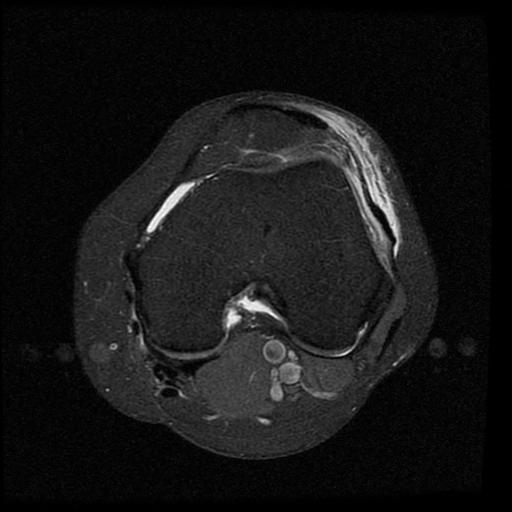 Figure 5 for case Lateral patellar retinaculum tear